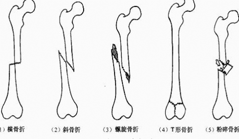 女子骨折手术两周后去世 司法鉴定称医院过错-云上资源整合网