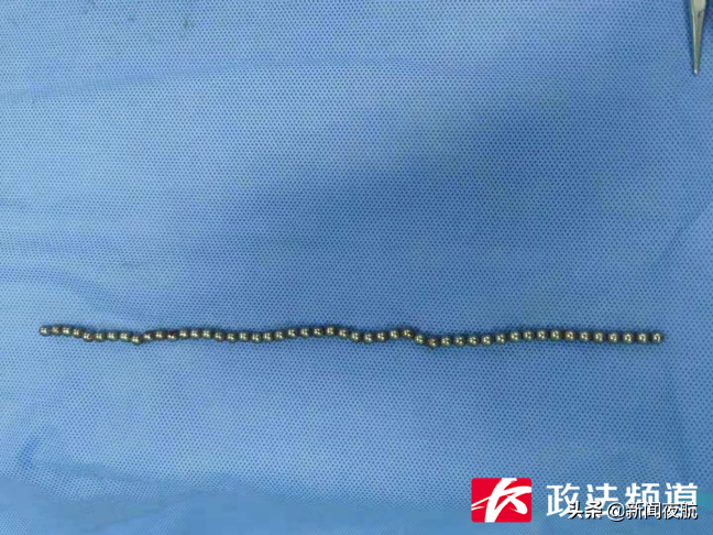 磁力珠手术_13岁男孩血尿医生取出20多颗磁力珠_取磁力珠手术会有后遗症吗